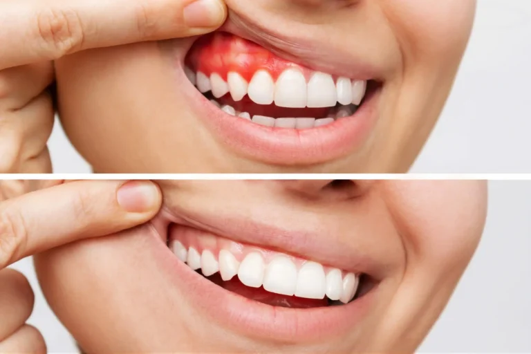 Exploring Professional Treatments for Gum Recession and Disease  