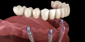 Affordable Dental Implants in Turkey A Complete Guide