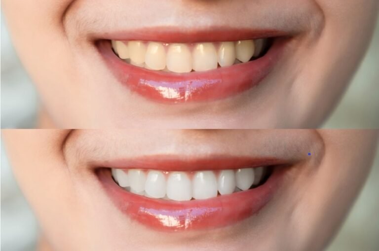 Before & After Using Crest 3D White Strips: Real Photos, Real Results
