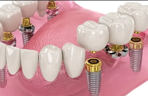 The Best Method for All-on-4 Dental Implants Honest Advice Before You Choose a Dentist