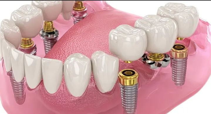 The Best Method for All-on-4 Dental Implants Honest Advice Before You Choose a Dentist